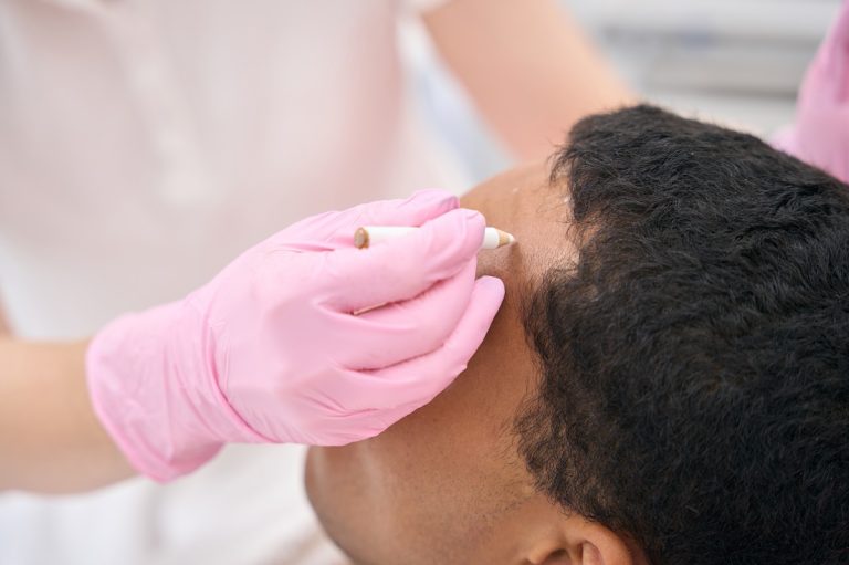 Pérdida de cabello y entradas antes de implante de pelo