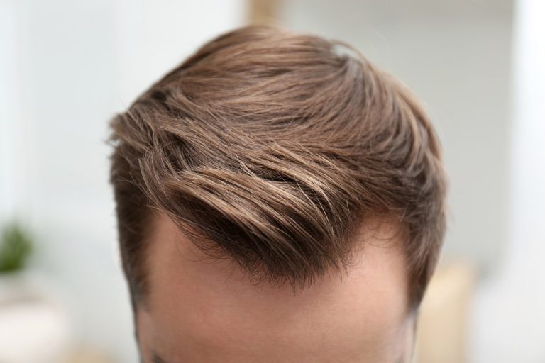 Hombre con ligera pérdida de cabello observando la zona frontal antes de realizarse un injerto capilar en Dos Hermanas